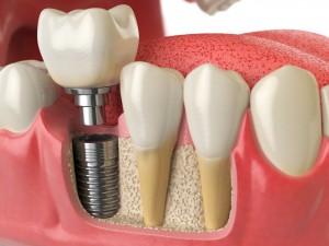 implanttsiya-zubov